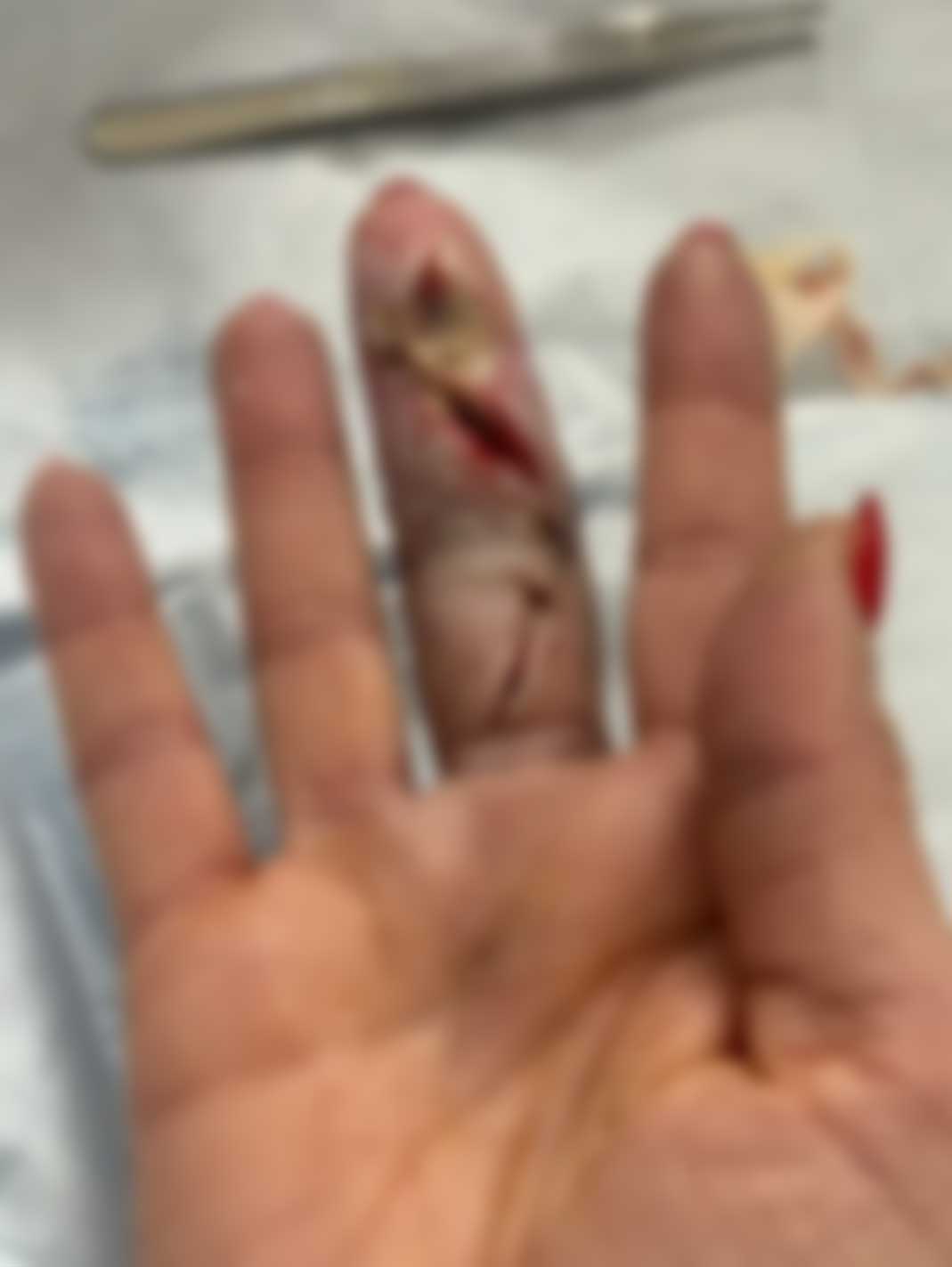 前WWE明星拉娜手指感染后续,手术后发布触目惊心的照片