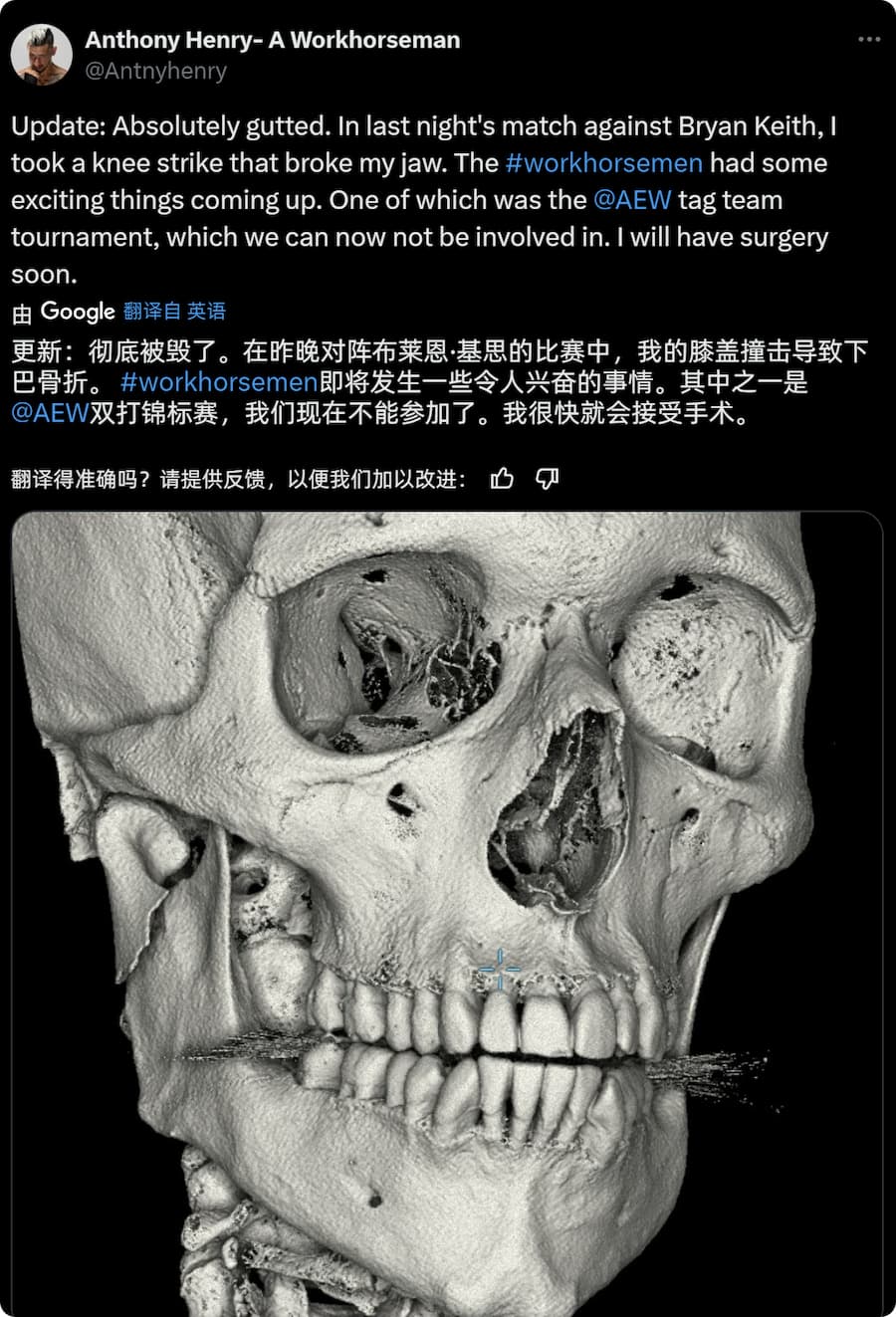 AEW选手在比赛中下巴骨折,准备接受手术治疗